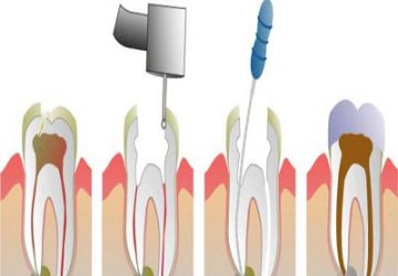 درمان ريشه دندان چيست؟