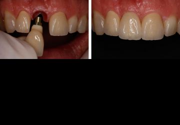 فاصله زمانی مناسب بین کشیدن دندان تا ایمپلنت گذاری چقدر است؟