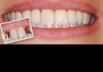 عوامل لق شدن ایمپلنت دندان