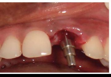 عوامل شکست ایمپلنت دندان چه هستند؟