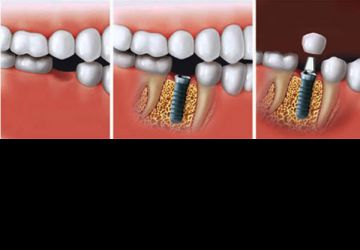 ایمپلنت دندان چه تفاوتی با دندان طبیعی دارد؟