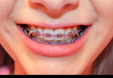 آیا ارتودنسی روش مناسبی برای پیشگیری از بیماری­های فک و دندان است؟