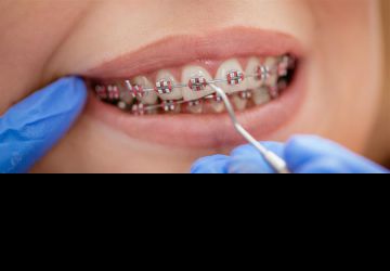 آیا با وجود روکش دندان هم ارتودنسی امکانپذیر است؟