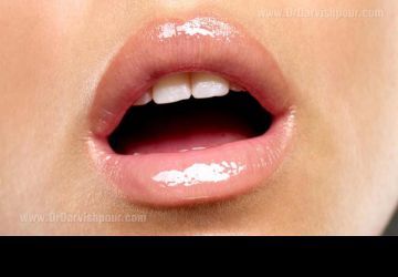 درمان ارتودنسی در بدشکلی دندان‌ها به دلیل تنفس دهانی