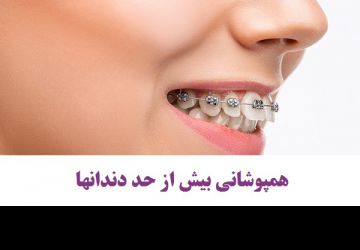 راه درمان همپوشانی دندانها