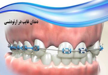 دندان غایب در ارتودنسی