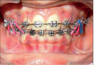نقش ارتودنسی در برطرف کردن ضایعات دهانی