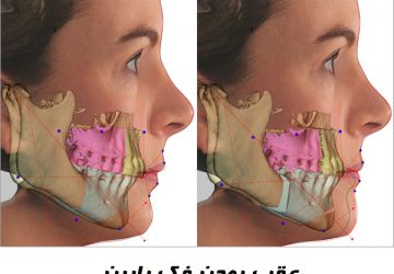 عقب بودن فک پایین