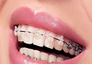 عقب بردن دندان ها به کمک ارتودنسی