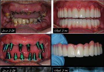 مراحل کاشت ایمپلنت دندان
