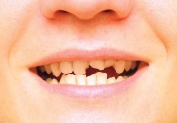 در چه صورتی لمینت از دندان جدا می شود؟