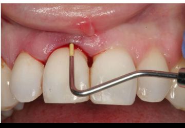  جرم دندان چیست؟