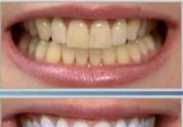 رابطه ی جرم گیری دندان و لق شدن دندان ها در چیست؟