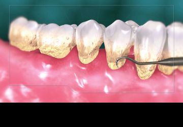  جرم گیری دندان به چند طریق انجام می شود؟