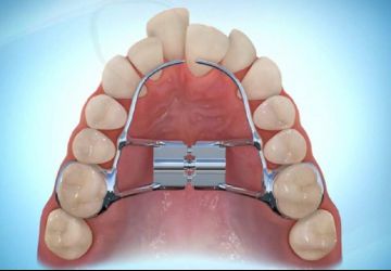 اکسپندر دندان چیست؟