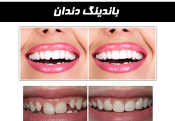 باندینگ دندان چیست؟