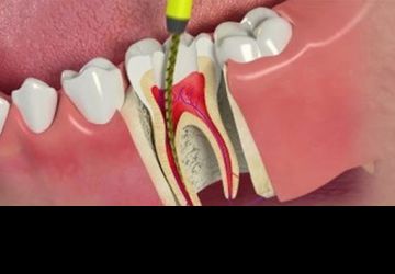 مراحل عصب کشی و پرکردن دندان