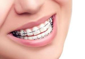 انواع مختلف ارتودنسی و ارتودنسی مناسب دندان شما