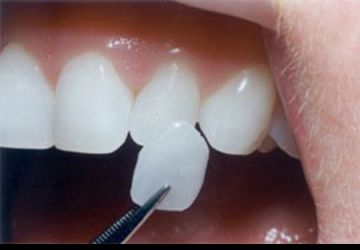 مراحل انجام لمینت دندان