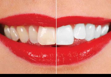 سفید کردن دندان‌ها یا بیلیچینگ