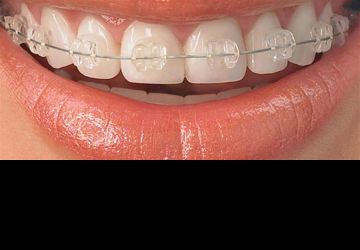  مراحل مختلف ارتودنسی دندان