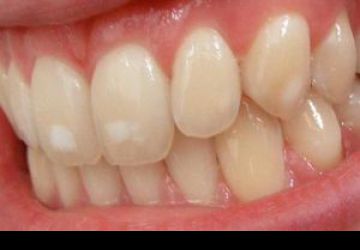 علت لکه‌های سفید روی دندان