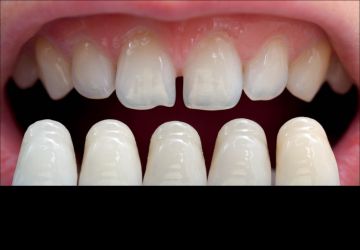 روش کار دندانپزشکان زیبایی در انجام لمینت دندان