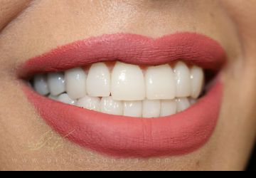دقت دندانپزشک در انجام لمینت دندان اهمیت خاصی دارد