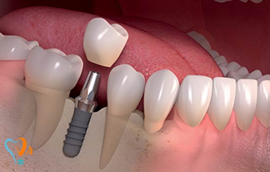 عملی به نام «ایمپلنتولوژی»!