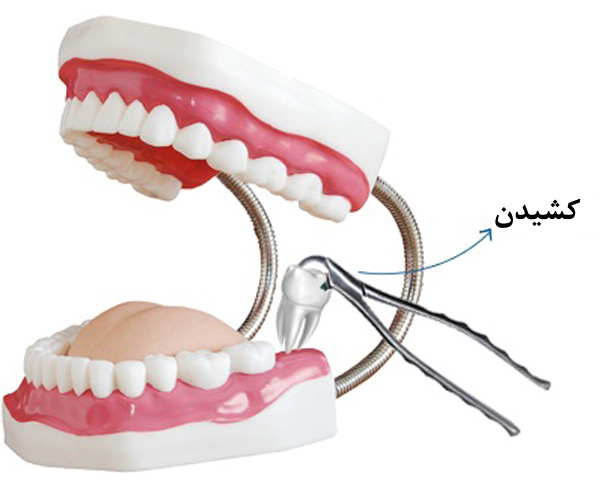 عصب کِشی یا عصب کُشی؟